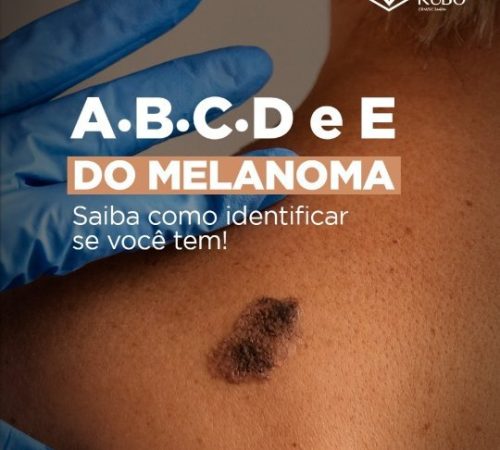 a.b.c.d.c melanoma