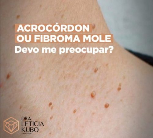 acrocordon